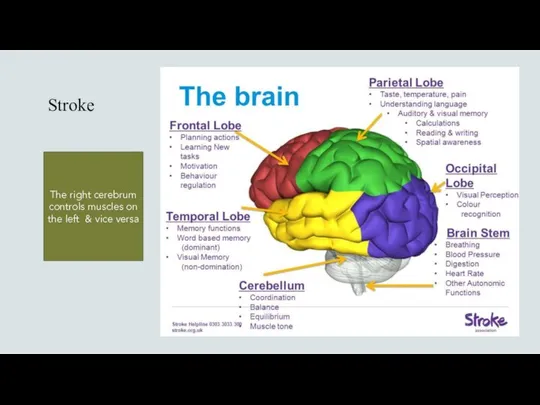 Stroke The right cerebrum controls muscles on the left & vice versa