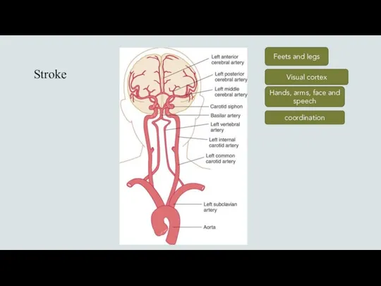 Stroke Feets and legs Hands, arms, face and speech Visual cortex coordination