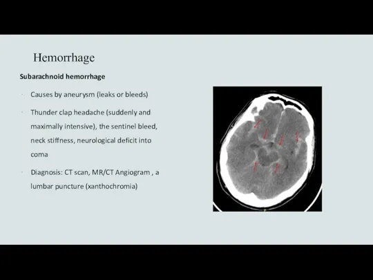 Hemorrhage Subarachnoid hemorrhage Causes by aneurysm (leaks or bleeds) Thunder clap