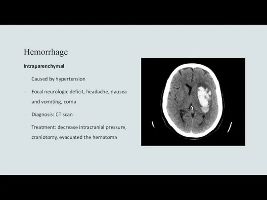 Hemorrhage Intraparenchymal Caused by hypertension Focal neurologic deficit, headache, nausea and