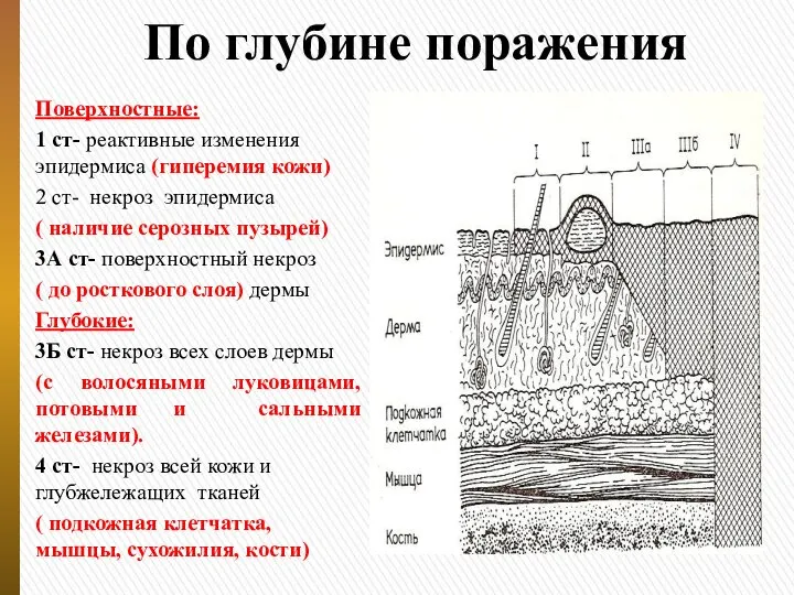 По глубине поражения Поверхностные: 1 ст- реактивные изменения эпидермиса (гиперемия кожи)