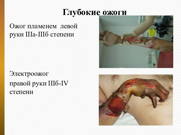 Глубокие ожоги Ожог пламенем левой руки IIIа-IIIб степени Электроожог правой руки IIIб-IV степени