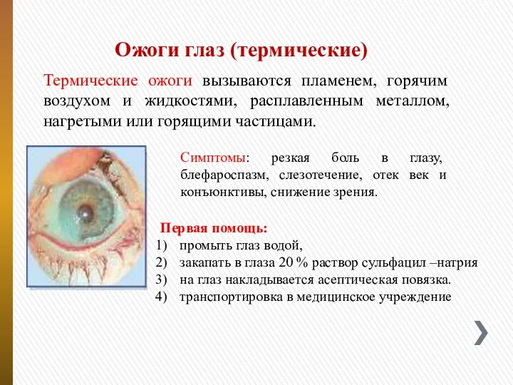 Ожоги глаз (термические) Термические ожоги вызываются пламенем, горячим воздухом и жидкостями,