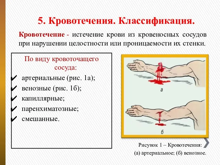 5. Кровотечения. Классификация. Кровотечение - истечение крови из кровеносных сосудов при