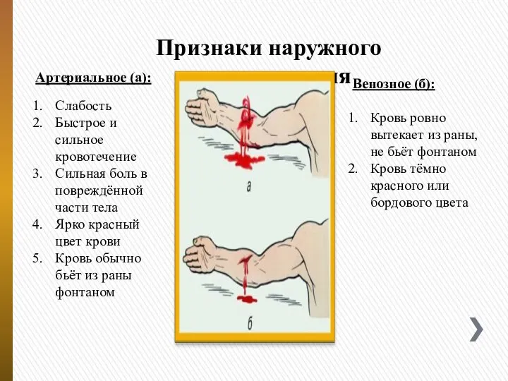 Признаки наружного кровотечения Слабость Быстрое и сильное кровотечение Сильная боль в