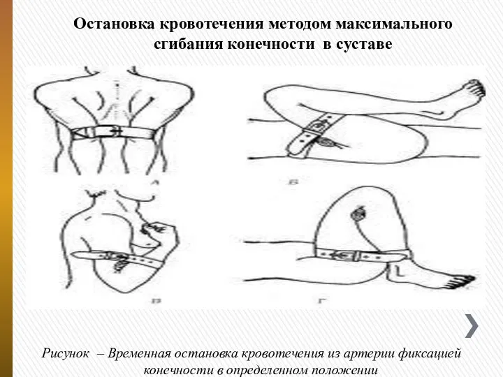 Остановка кровотечения методом максимального сгибания конечности в суставе Рисунок – Временная