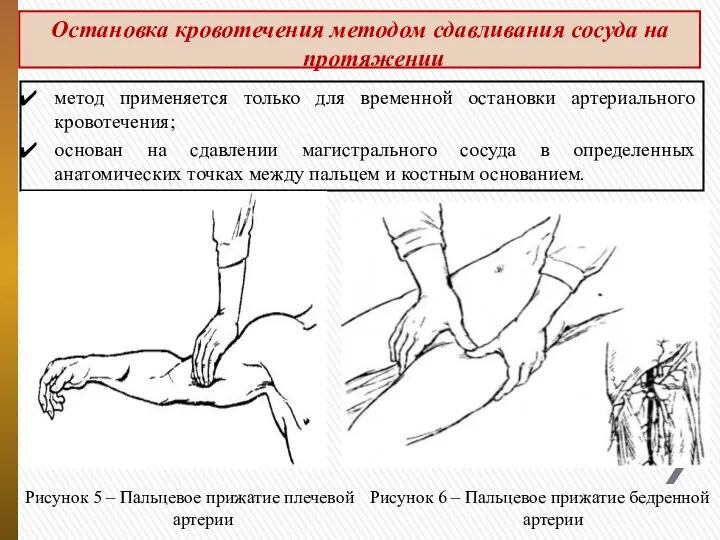 Остановка кровотечения методом сдавливания сосуда на протяжении метод применяется только для