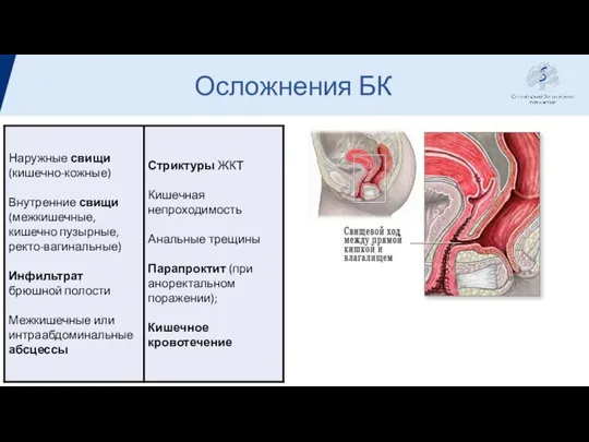 Осложнения БК