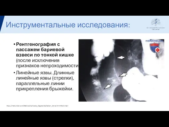 Инструментальные исследования: Рентгенография с пассажем бариевой взвеси по тонкой кишке (после