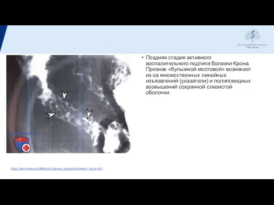 Поздняя стадия активного воспалительного подтипа болезни Крона. Признак «булыжной мостовой» возникает