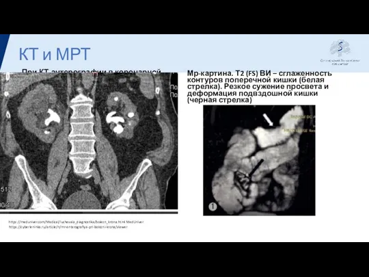 КТ и МРТ При КТ-энтерографии в коронарной проекции у другого пациента