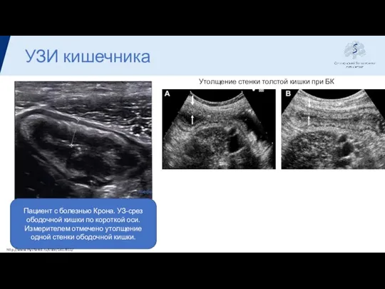 УЗИ кишечника Пациент с болезнью Крона. УЗ-срез ободочной кишки по короткой