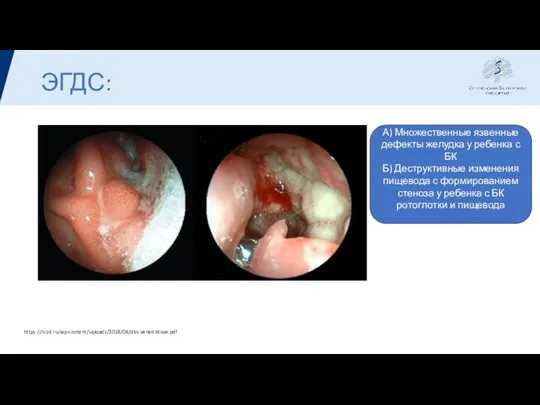 ЭГДС: А) Множественные язвенные дефекты желудка у ребенка с БК Б)