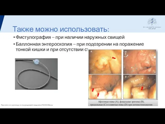 Также можно использовать: Фистулография – при наличии наружных свищей Баллонная энтероскопия