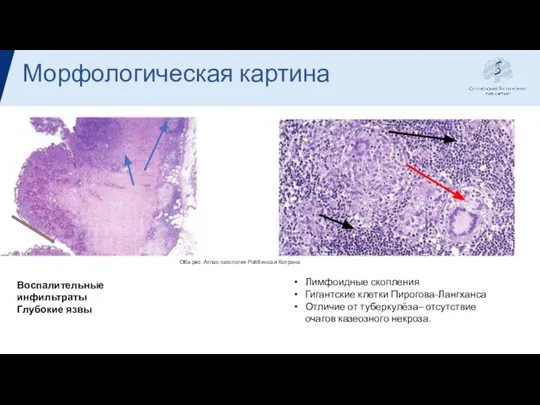 Морфологическая картина Воспалительные инфильтраты Глубокие язвы Лимфоидные скопления Гигантские клетки Пирогова-Лангханса