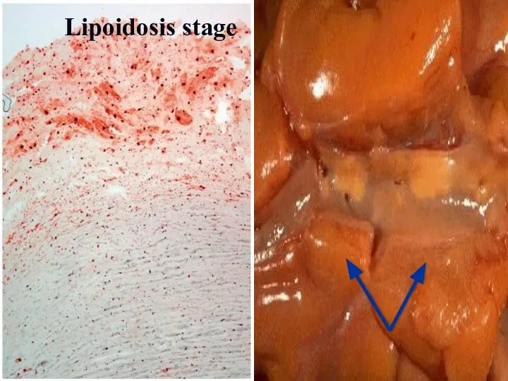 Lipoidosis stage