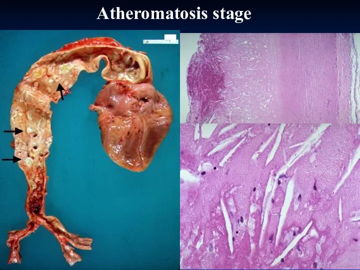 Atheromatosis stage
