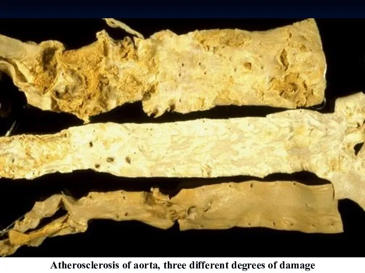 Atherosclerosis of aorta, three different degrees of damage