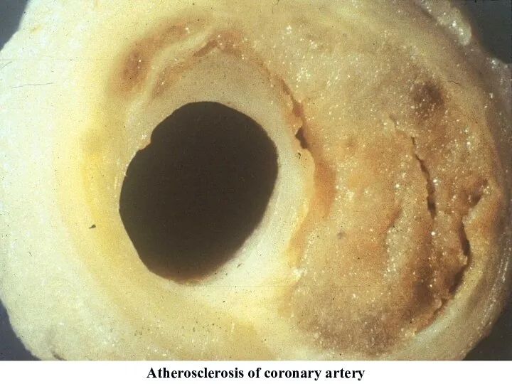 Atherosclerosis of coronary artery