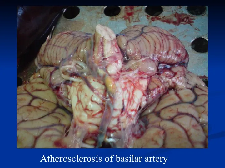 Atherosclerosis of basilar artery