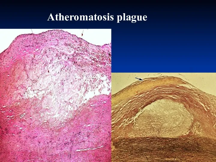 Atheromatosis plague