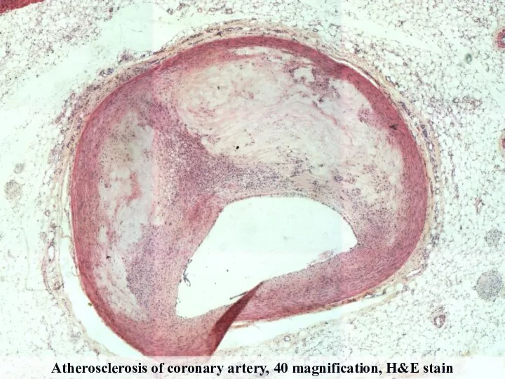 Atherosclerosis of coronary artery, 40 magnification, H&E stain