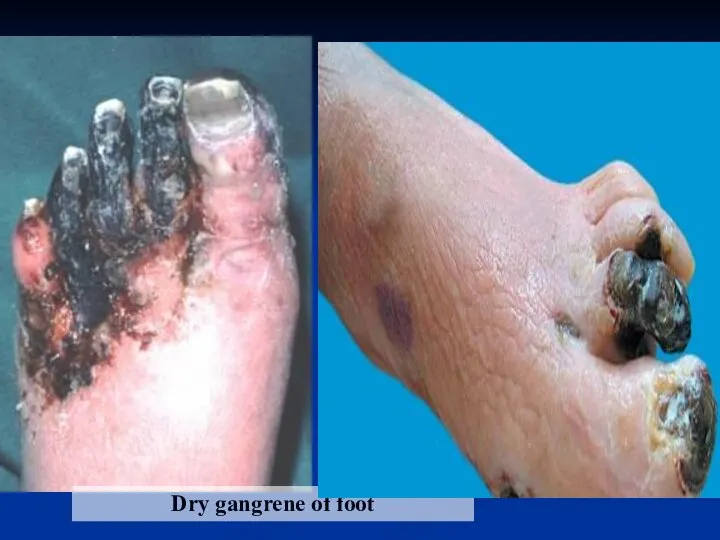 Dry gangrene of foot Necrosis in heart wall