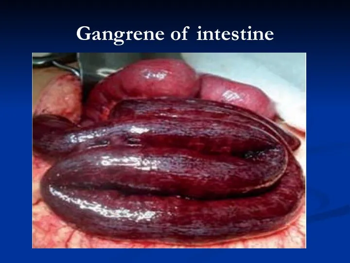 Gangrene of intestine