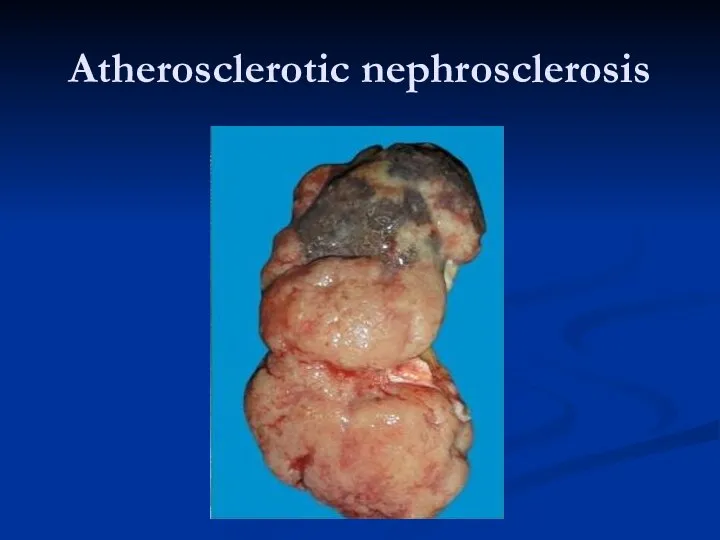 Atherosclerotic nephrosclеrosis