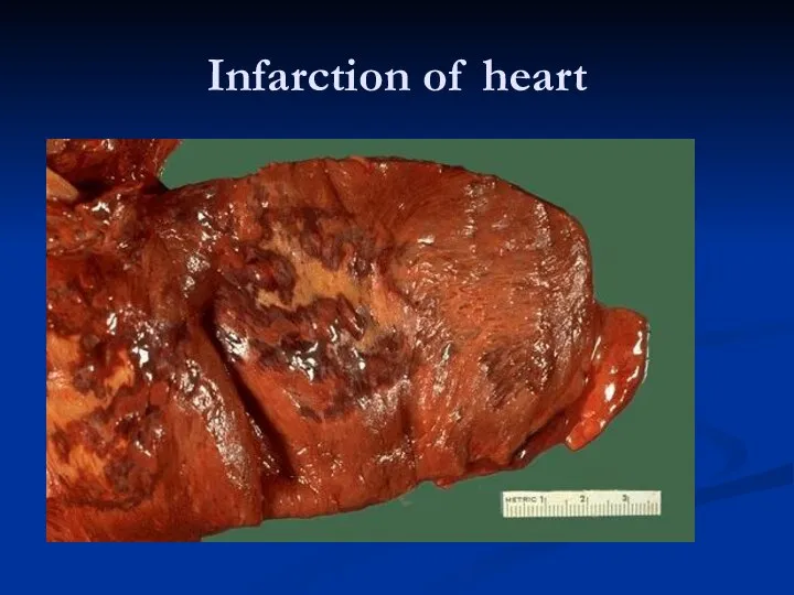 Infarction of heart