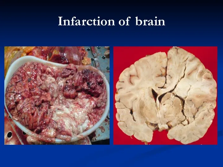 Infarction of brain