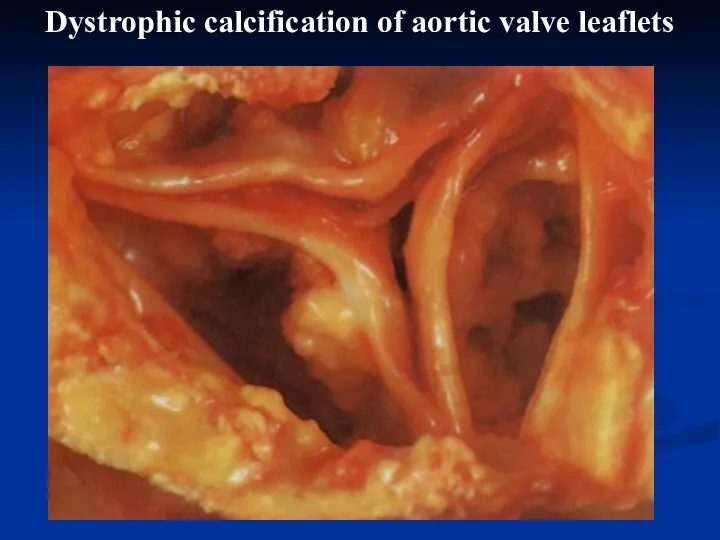 Dystrophic calcification of aortic valve leaflets