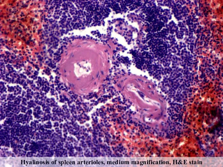 Hyalinosis of spleen arterioles, medium magnification, H&E stain