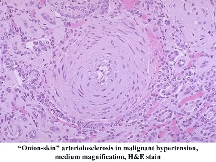“Onion-skin” arteriolosclerosis in malignant hypertension, medium magnification, H&E stain