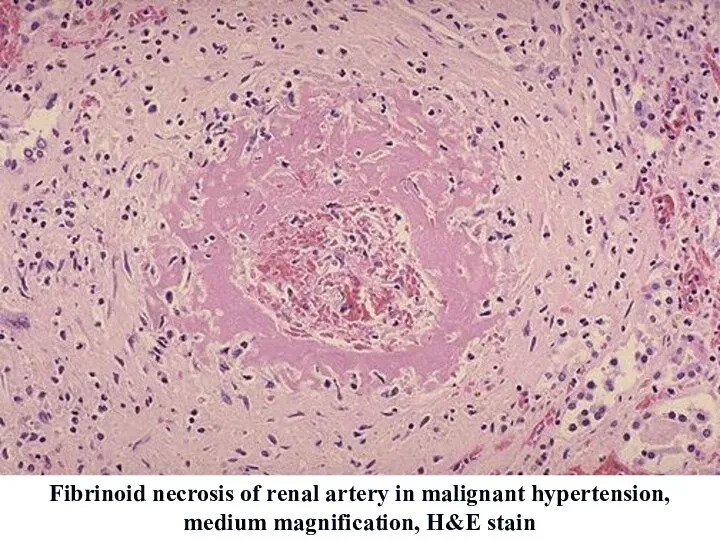 Fibrinoid necrosis of renal artery in malignant hypertension, medium magnification, H&E stain