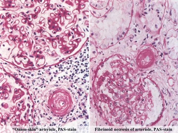 “Onion-skin” arteriole, PAS-stain Fibrinoid necrosis of arteriole, PAS-stain