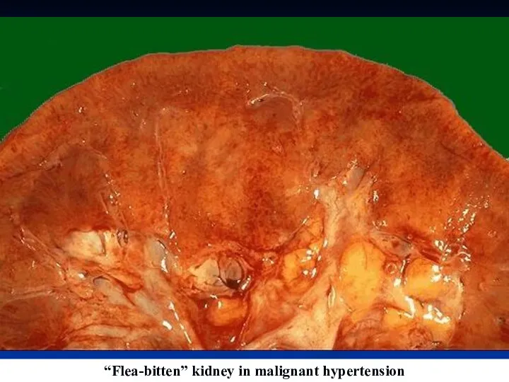 “Flea-bitten” kidney in malignant hypertension