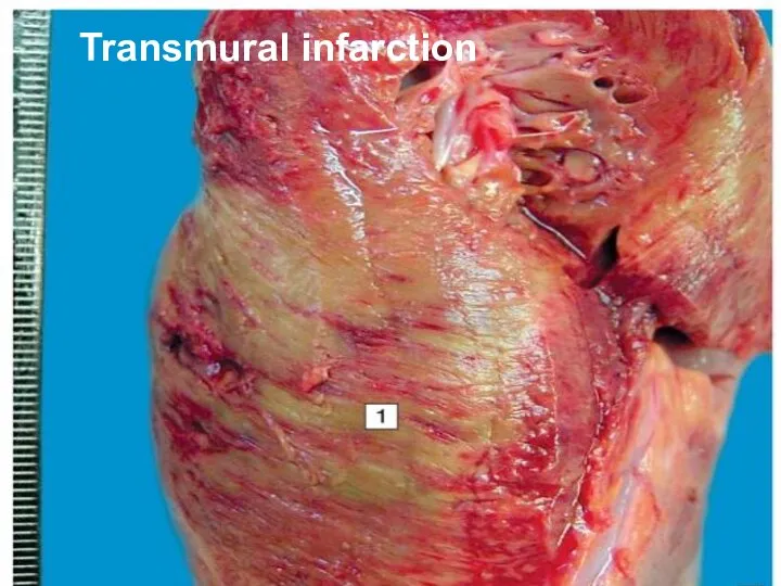 Transmural infarction