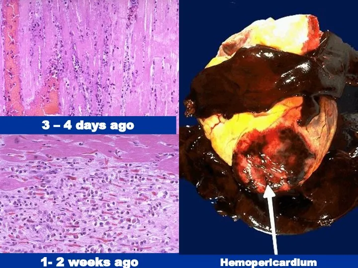 3 – 4 days ago 1- 2 weeks ago Hemopericardium
