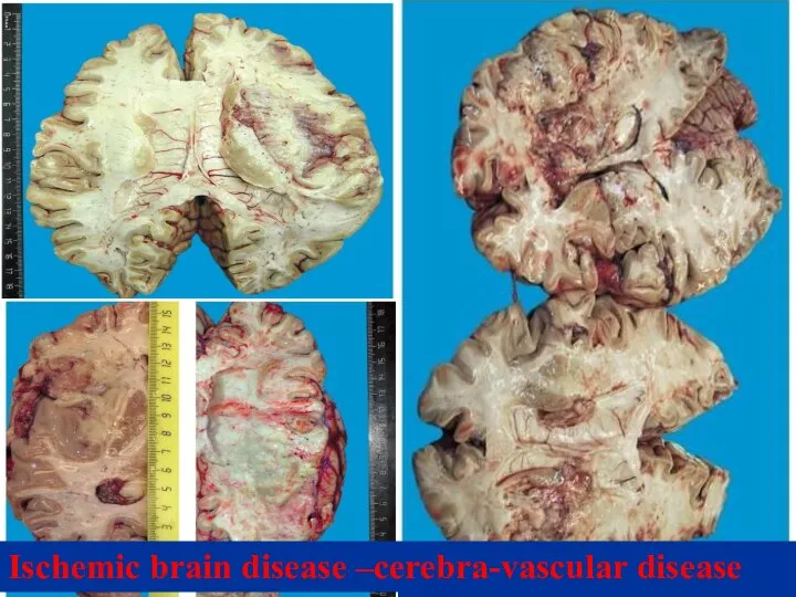 Ischemic brain disease –cerebra-vascular disease