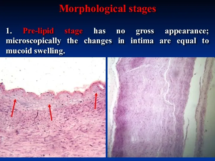 1. Pre-lipid stage has no gross appearance; microscopically the changes in