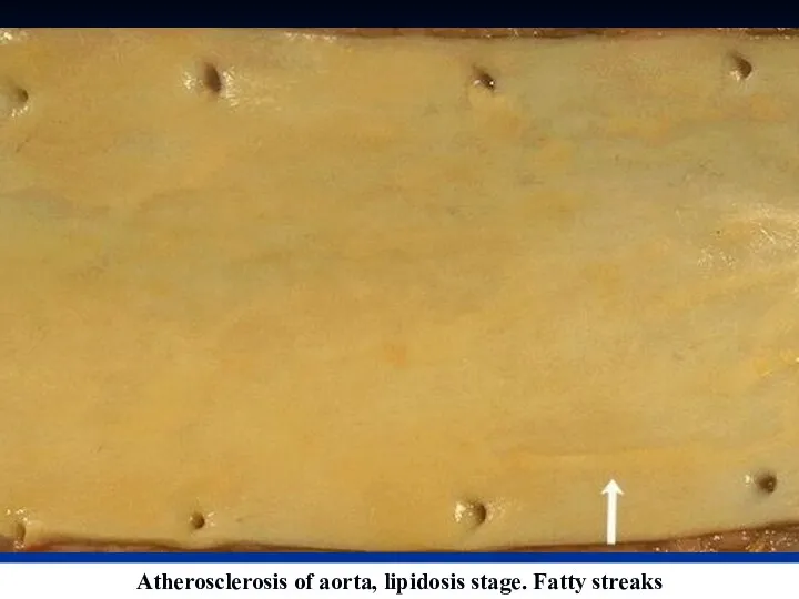 Atherosclerosis of aorta, lipidosis stage. Fatty streaks