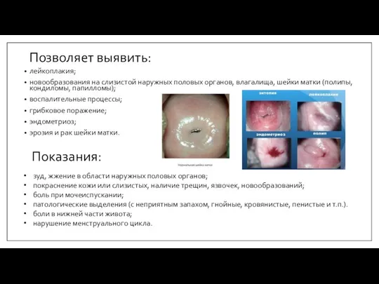 Позволяет выявить: лейкоплакия; новообразования на слизистой наружных половых органов, влагалища, шейки