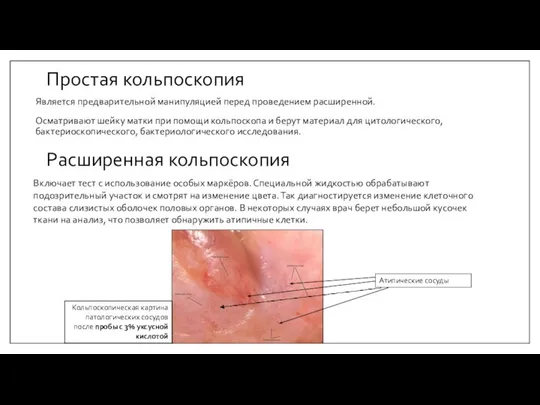 Простая кольпоскопия Является предварительной манипуляцией перед проведением расширенной. Осматривают шейку матки