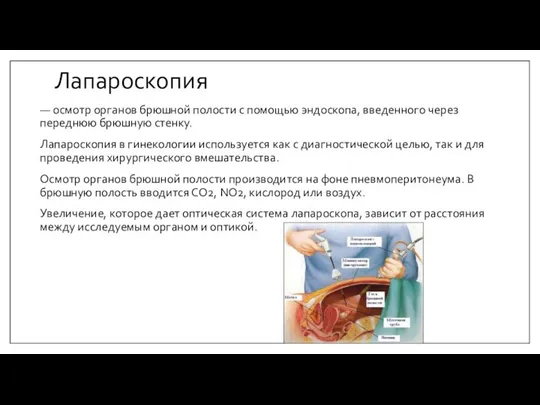 Лапароскопия — осмотр органов брюшной полости с помощью эндоскопа, введенного через