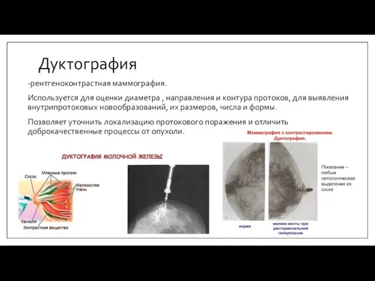 Дуктография -рентгеноконтрастная маммография. Используется для оценки диаметра , направления и контура