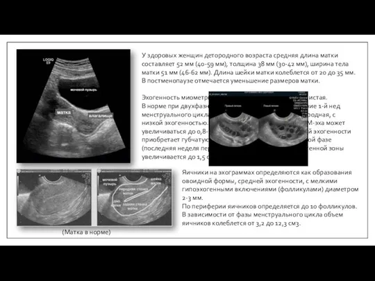 (Матка в норме) У здоровых женщин детородного возраста средняя длина матки