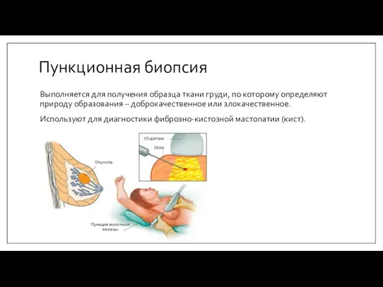 Пункционная биопсия Выполняется для получения образца ткани груди, по которому определяют