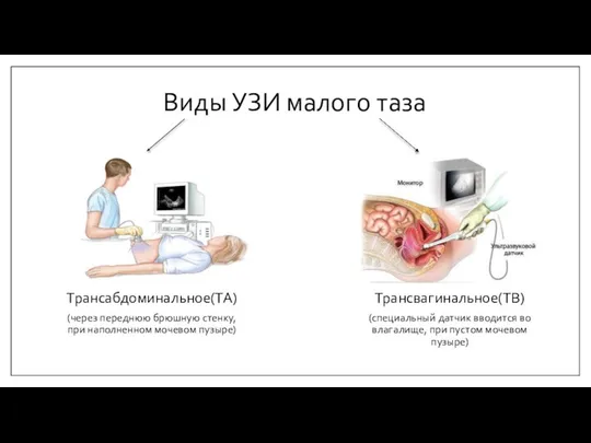 Виды УЗИ малого таза