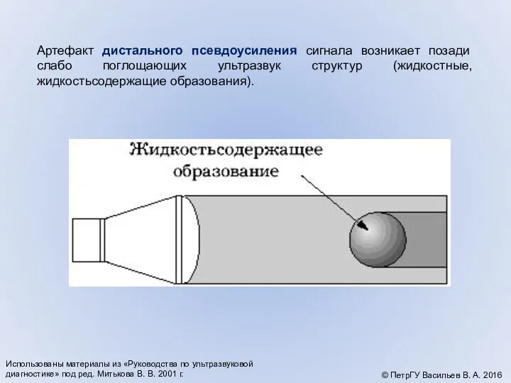 Артефакт дистального псевдоусиления сигнала возникает позади слабо поглощающих ультразвук структур (жидкостные,